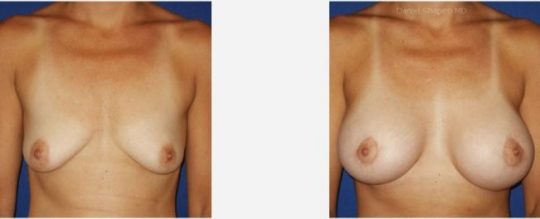 Photos avant après lifting seins