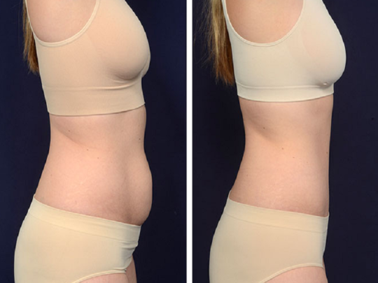 abdominoplastie avant apres