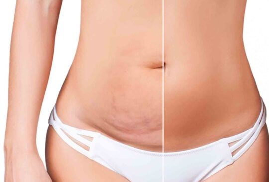 abdominoplastie turquie